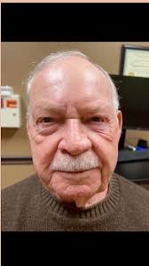 Mohs defect from BCC of the nose was no match for Dr. Strohl-Bryan. #mohs  #facialplasticsurgery #foreheadflaps #beforeandafter #beautiful #nose #ent  #bcc