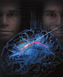 Cingulum stimulation enhances mood during awake neurosurgery p. 2