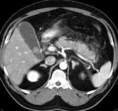 Maybe you would like to learn more about one of these? Imaging Assessment Of Etiology And Severity Of Acute Pancreatitis Pancreapedia