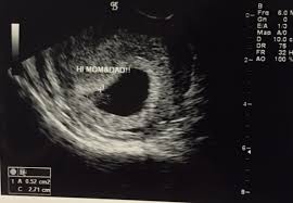 Check spelling or type a new query. Heartbeat 6 Weeks Pregnant Ultrasound Novocom Top