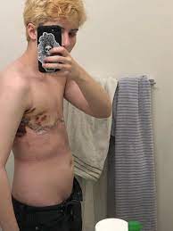 cats can have a little salami — more pictures of my chest 1 week post op w  dr...