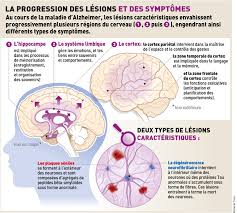 La chercheuse dit espérer que cette étude ouvre les esprits des cliniciens qui tentent de diagnostiquer la démence, en les aidant à comprendre que la perte de mémoire n'est pas présente chez tous les personnes atteintes de la maladie d'alzheimer. Maladie D Alzheimer Que Se Passe T Il Dans Le Cerveau