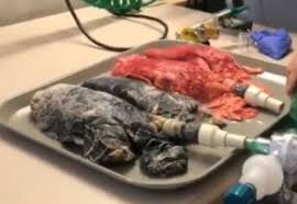 Je sais que les campagnards sont fortement exposés aux pesticides des champs qui ressemblent de plus en plus à. Poumons De Fumeurs La Video Choc D Une Infirmiere Egora Fr