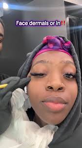Getting A Dermal in My Face