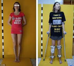 Aspiring Model Who Was Too Short Has Legs Surgically Lengthened Model Short Legs Cheer Skirts