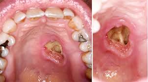 Image result for spinocellular carcinoma of the oral cavity