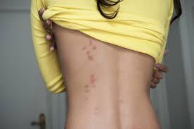 Image result for flea bites