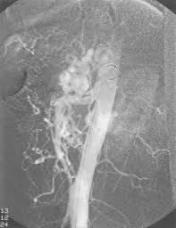 This is a community for people who have ehlers danlos syndromes, hypermobility spectrum disorder, are suspected of having either, and their friends and family. Visceral Aneurysms In Ehlers Danlos Syndrome Case Report And Review Of The Literature Journal Of Vascular Surgery