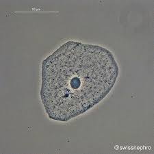 Squamous Epithelial Cell Phase Contrast Original Magnification X400 Urinarysediment Urine Nephrology Nephpearls Kidney Renal Squamous Renal Pathology