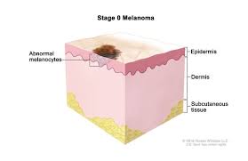 Skin cancer is the most common type of cancer in humans. Definition Of Melanoma In Situ Nci Dictionary Of Cancer Terms National Cancer Institute