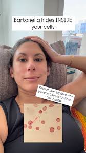 At the Annual AlzPI & PCOM Symposium, I sat down with a researcher who  broke down why Bartonella can be so hard to treat — and it blew my mind! ,  Bartonella is what’s known as an intracellular ...