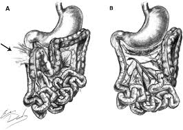 Image result for Intestinal Malrotation