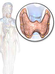 Aortic valve disease is a condition in which the valve between the main pumping chamber of your heart (left ventricle) and the main artery to your body (aorta) doesn't work properly. Thyroid Disease Wikipedia