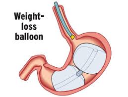 doctors to study stomach balloon for