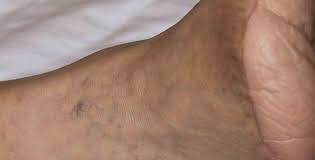 Sie ist damit die grundlage jeder effektiven wundbehandlung, sollte aber auch als ein wichtiges instrument zur sicherung der behandlungsqualität gesehen und akzeptiert werden. Die Wundzentrale Lohmann Rauscher Home