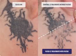 Tattoos that have not been effectively removed by other treatments or through home remedies may respond well to laser therapy providing the prior treatments did not result in excessive scarring. Tattoo Removal Results And Before After Photos Describe Patch