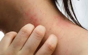 See full list on mayoclinic.org Chlorine Rash Symptoms Causes And Prevention