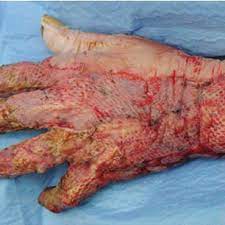 Often called a black wound, the scab may appear black with a thick collection of dry tissue. Pdf The Woundwand And Its Novel Use In Burn Excision Surgery