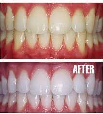 14 Tips For Beautiful Healthy Teeth Health And Beauty Beauty Hacks Health