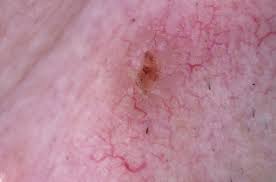 According to a paper from 2009, skin cancer makes up as much as 45% of all cancers in white people, 5% of all cancers in hispanic people, 4% of all cancers in asian people, and 2% of all cancers in black people. White And Black Skin Cancer Heine Optotechnik