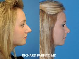 Cosmetic surgery clinic in appleton , wi. Rhinoplasty Parfitt Facial Plastic Surgery Center
