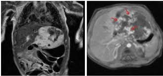 Hemangiomer er vanligvis mindre enn 5 centimeter (cm) over. Rapidly Involuting Congenital Haemangioma Of The Liver Bmj Case Reports