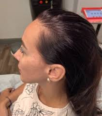 TED Hair Restoration Brooklyn & Staten Island