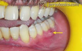 Image result for Periodontal Abscess