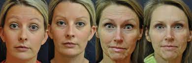We did not find results for: 14 Things I Wish I Knew Before Botox Botox Forum