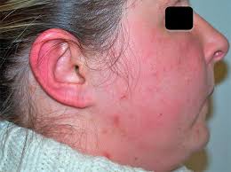 Image result for phlegmon on face)