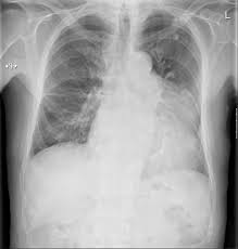 A loculated pleural effusion is the major radiographic hallmark of parapneumonic effusion or empyema (see fig. Loculated Pleural Effusion Radiology Case Radiopaedia Org