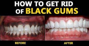 How To Get Rid Of Black Gums Fb Hair Fall Remedy Reduce Hair Fall Fall Hair