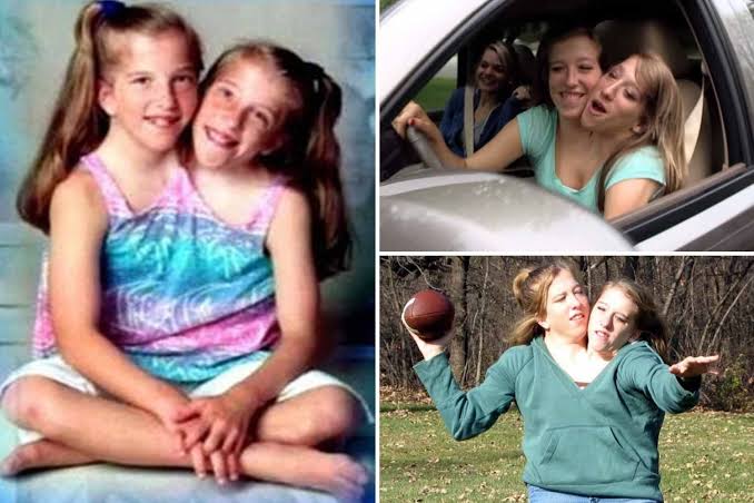 World's most famous conjoined twins, 29, learn to drive and go to uni  despite fears they would not survive