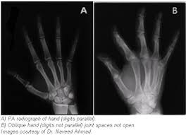 Image result for Normal Anatomic Position of the Hand and Wrist