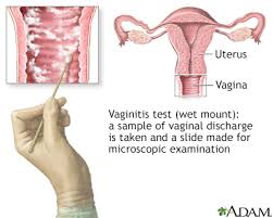 Image result for Vaginitis