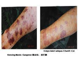 Kencing manis (diabetes) adalah kumpulan penyakit metabolik kronik yang menyebabkan tahap gula dalam darah (glukosa) yang tinggi di dalam badan. Kencing Manis My Blog