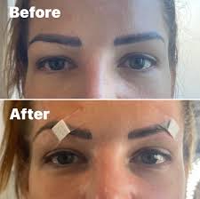 Hey girls! Hope you're all doing great 💕 I'm getting a brow lift and upper  bleph soon, and I just wanted to ask if anyone had any issues with nerve  sensitivity afterwards?