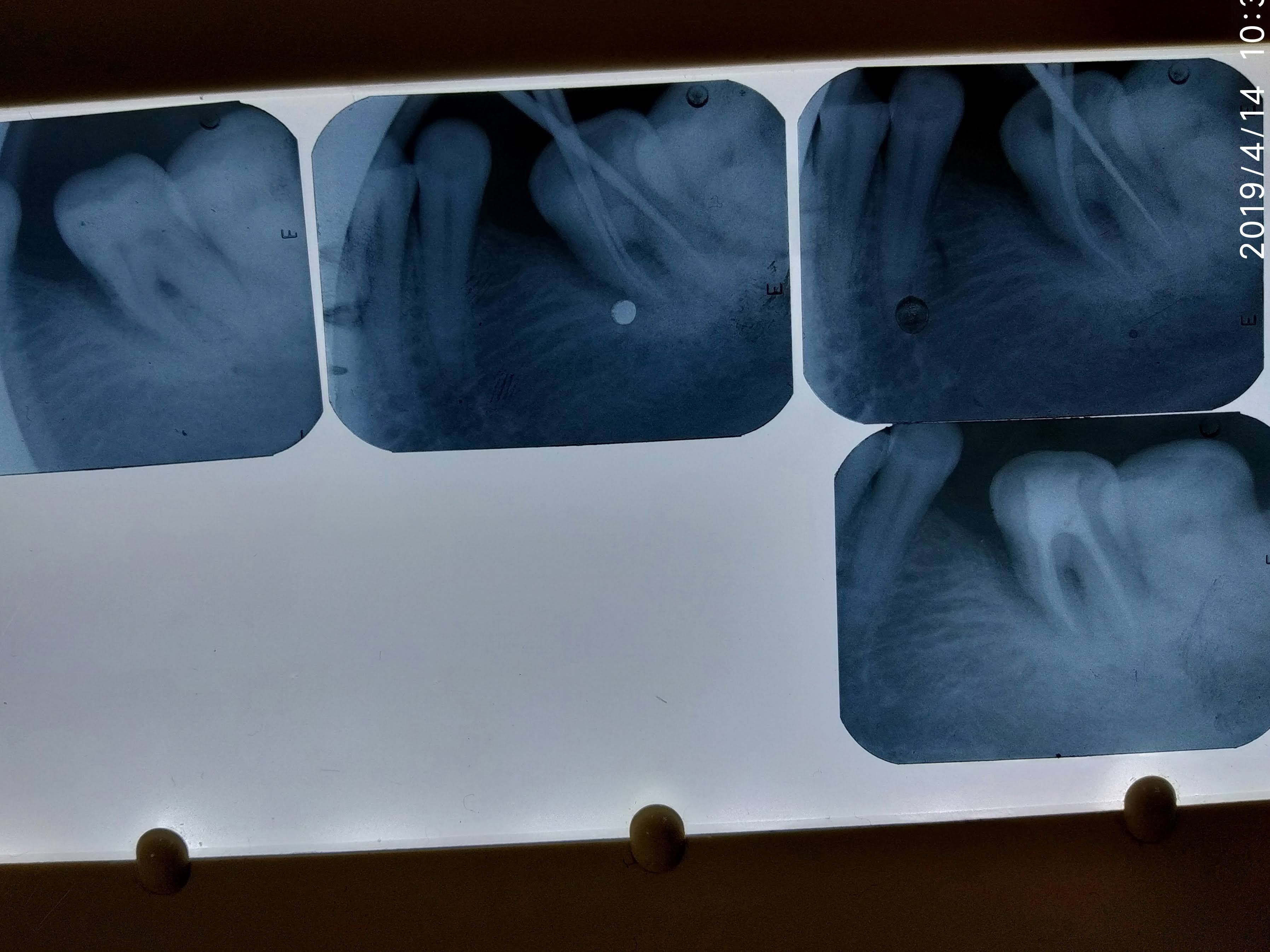 RootCanal Treatment product image