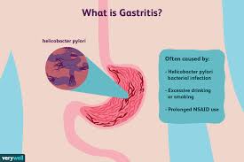 Moreover, these are not necessarily signs of gastrointestinal damage the indication for the implementation of the proximal subtotal gastrectomy is the presence of early gastric cancer in its upper third without a. Gastritis Overview And More