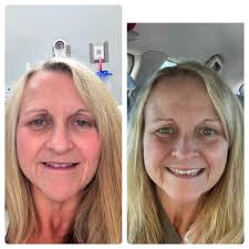 Before and after surgery recovery photos