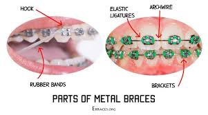 everything you need to know about rubber bands for braces