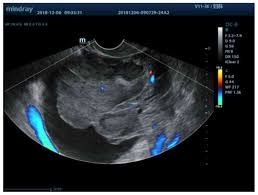Find great deals on ebay for color doppler ultrasound. Comparison Of Image Features And Diagnostic Value Of Color Doppler Ultrasound And Two Dimensional Ultrasound In The Diagnosis Of Ovarian Sex Cord Stromal Tumors