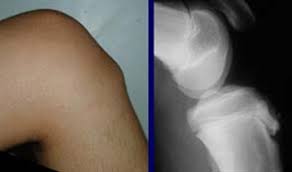 Osgood Schlatter hay bệnh viêm lồi củ trước xương chầy - Kiến thức phổ thông