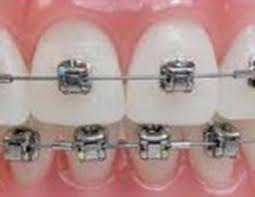 How to get braces for free in ireland. Damon Braces Orthodontics The James Clinic