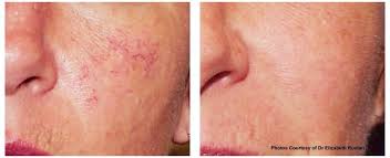 Maybe you would like to learn more about one of these? Broken Capillaries In Perth Vice Aesthetics