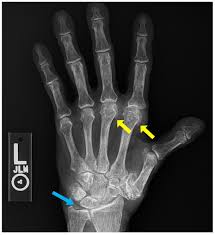 Image result for XRay Changes in Rheumatic Conditions