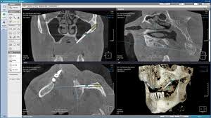 La cati mai multi temerari, la cat mai mult fun!! Pret Implant Dentar Cat Costa Un Implant Implantodent