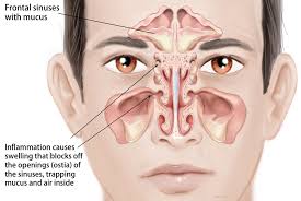 They line the inside of your nose or your sinuses. Ent Sinus Children Otolaryngology Specialists Of North Texas