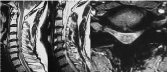 Cervical spondylosis is seen more in people who have computer jobs or jobs which however, symptoms are present if the herniation or slipped disc leads to excessive pressure on the. A Case Of Adjacent Segment Disc Herniation Following A Cervical Laminoplasty