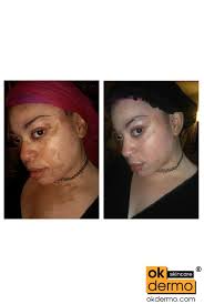 Buy Benoquin® Monobenzone Cream 20% Online